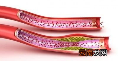 丹参片能清理血管垃圾吗可以长期服用吗