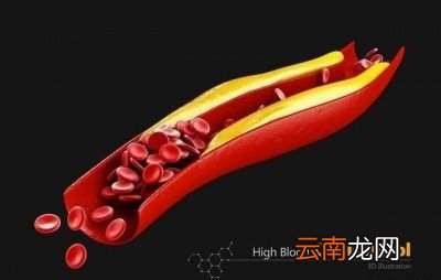 丹参片能清理血管垃圾吗可以长期服用吗