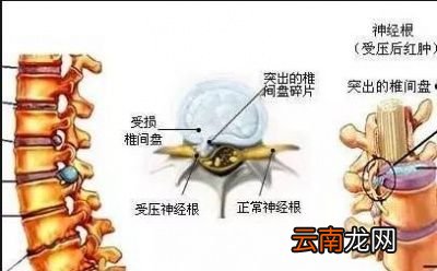 为什么说颈椎病的治疗不存在任何偏方