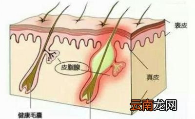 一化妆就长痘痘的各种原因分解