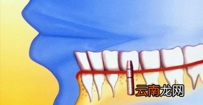 怎么挑选种植医生