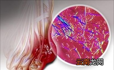 小苏打片能降尿酸吗