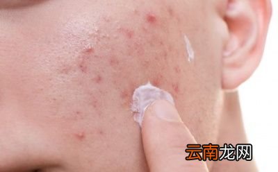 要去除掉脸上的痘痘这几个方面一定要注意
