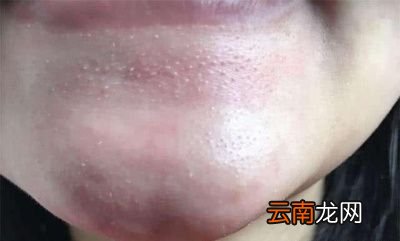 |下巴口周长痘痘怎么治疗