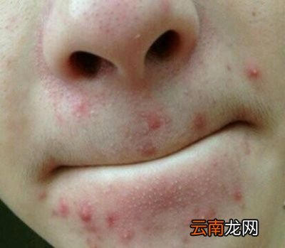 |下巴口周长痘痘怎么治疗