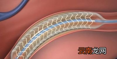 什么情况建议复查造影