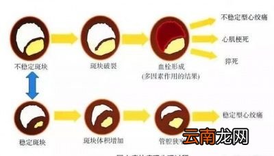 心绞痛发作的原因