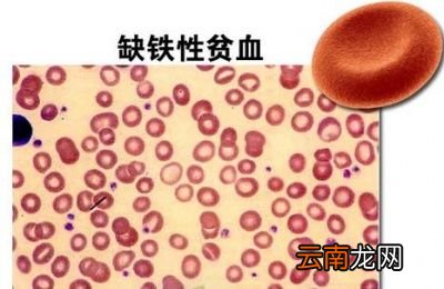 贫血吃什么怎么补铁