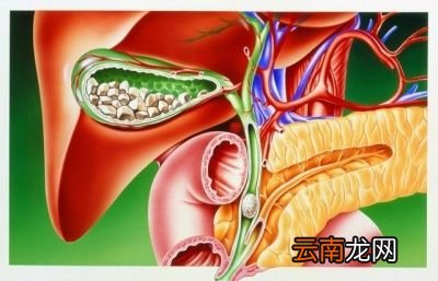 什么是椎间盘突出症