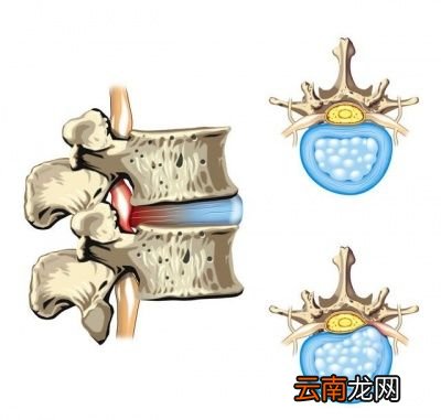 什么是椎间盘突出症
