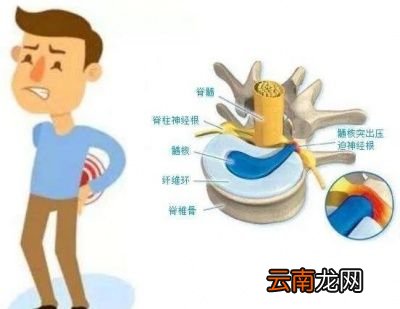 到底是治疗椎间盘突出还是治疗症状