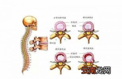 到底是治疗椎间盘突出还是治疗症状