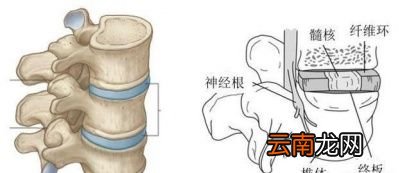 为什么说腰椎间盘突出和颈椎病不能根治呢