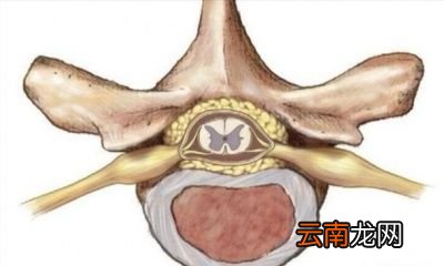 为什么说腰椎间盘突出和颈椎病不能根治呢