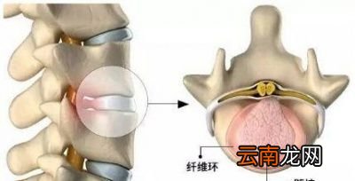 为什么说腰椎间盘突出和颈椎病不能根治呢
