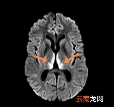 我们来谈谈酗酒对人体的影响会引发哪些疾病