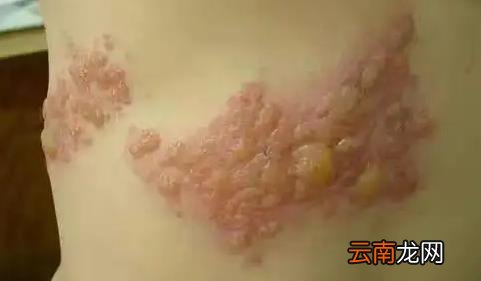 疱疹是必须发出来才能好吗 无缘无故怎么会得疱疹