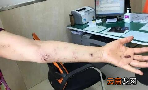 疱疹是必须发出来才能好吗 无缘无故怎么会得疱疹