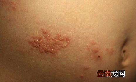 带状疱疹最怕三种菜你知道吗 疱疹三天自愈的最佳方法有哪些