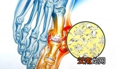 尿酸高的人不碰2物指的哪2物