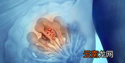 乳腺增生病会癌变吗