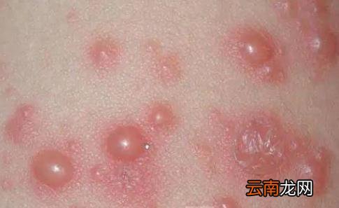 单纯疱疹为什么无法痊愈 单纯疱疹一辈子都不能康复吗