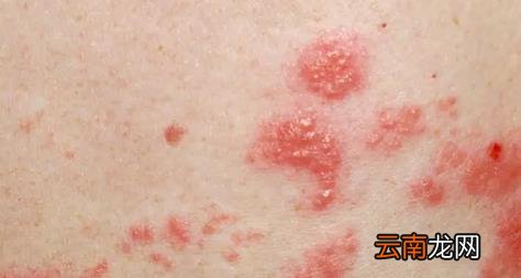 带状疱疹花了一万多还没治好怎么办 带状疱疹花了8000正常吗