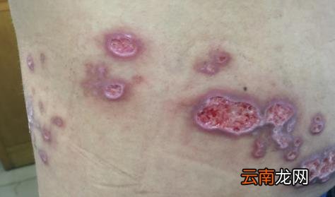 带状疱疹花了一万多还没治好怎么办 带状疱疹花了8000正常吗