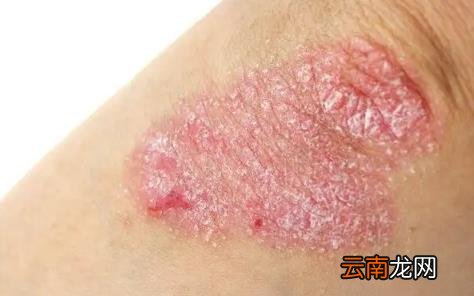 带状疱疹花了一万多还没治好怎么办 带状疱疹花了8000正常吗