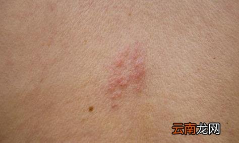 带状疱疹几天进入高峰后几天可以好 带状疱疹已经一周了还会传染正常吗