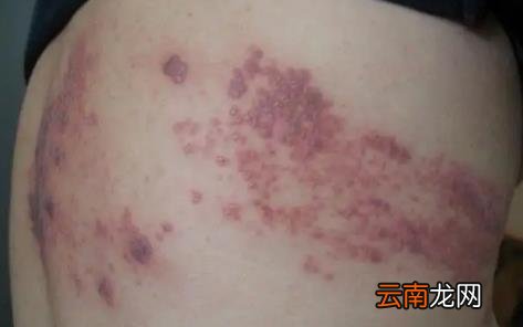 带状疱疹几天进入高峰后几天可以好 带状疱疹已经一周了还会传染正常吗