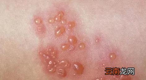 带状疱疹几天进入高峰后几天可以好 带状疱疹已经一周了还会传染正常吗