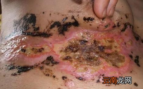 疱疹病毒一般都在什么地方感染 疱疹刚开始症状图片