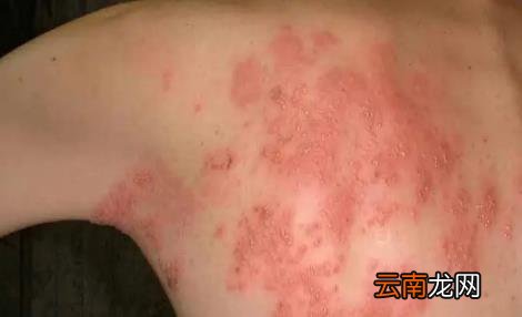 疱疹病毒一般都在什么地方感染 疱疹刚开始症状图片