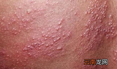 疱疹病毒一般都在什么地方感染 疱疹刚开始症状图片