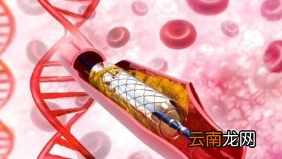 冠心病的治疗方法有哪些