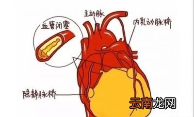 冠心病的治疗方法有哪些