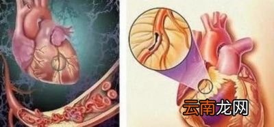 什么是冠心病最佳治疗的手段和方法是什么