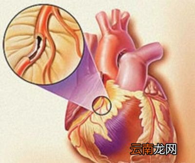 什么是冠心病最佳治疗的手段和方法是什么