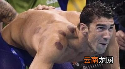 拔罐可以拔出湿气和寒气吗