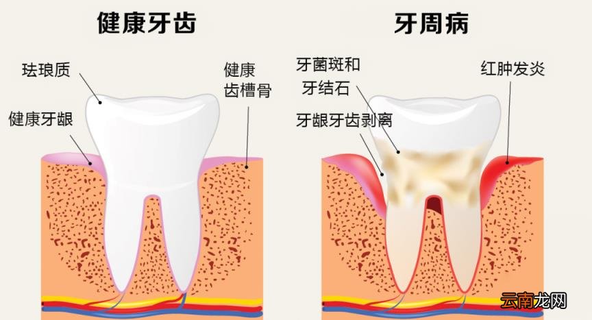 牙龈肿是牙周病吗?医师教你用 4 招“红、肿、软、松”判断