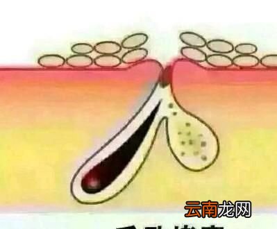 洗脸时用热水还是用凉水可以预防皮肤长痘