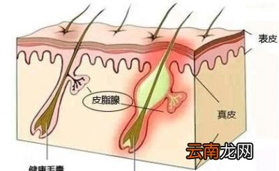 洗脸时用热水还是用凉水可以预防皮肤长痘