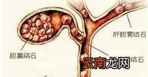 得了胆囊结石应该怎么办