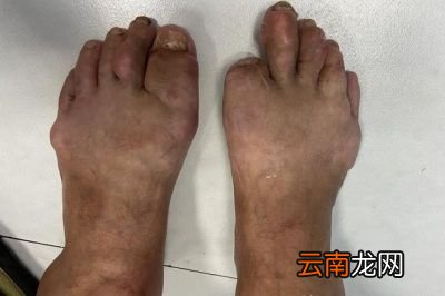 嘌呤尿酸高了会怎样