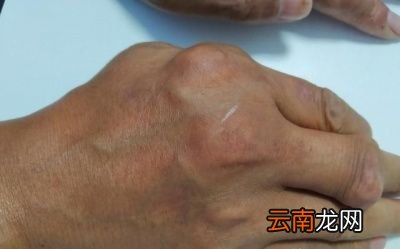 高嘌呤食物是让尿酸升高的主因吗