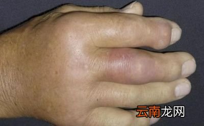 哪些食物中含嘌呤高