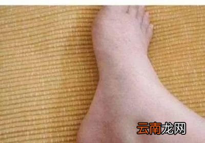 哪些食物中含嘌呤高
