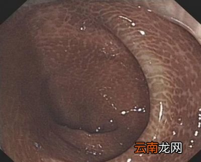 有哪些天然的食物是吴医生推荐便秘者食用的呢