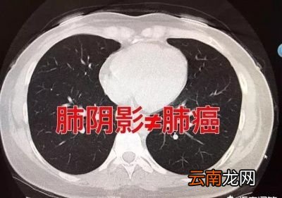 肺结节会变为肺癌吗